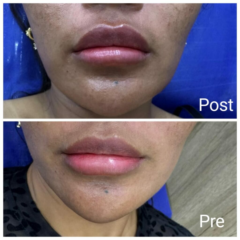 Lip fillers before and after